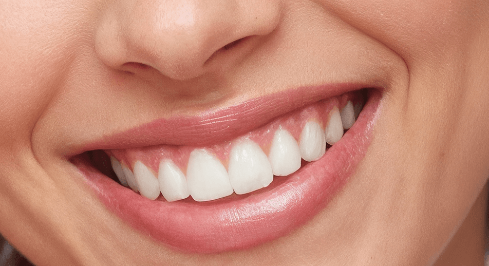 Gummy Smile Treatment Face360