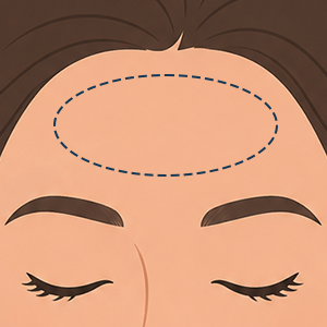 Forehead lines illustration Treatment Face360