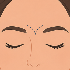Frownlines illustration treatment Face360