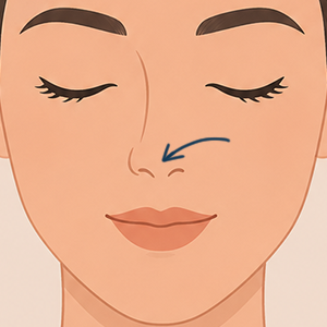 Nose tip lift illustration Face360 Treatment
