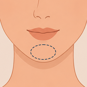 Orange Peel Skin Chin Dimpling - treatment illustration Face360