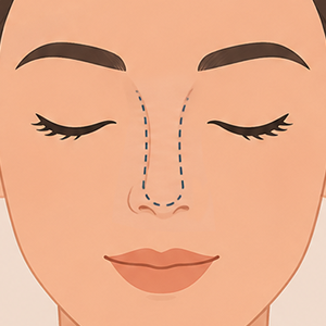 Nose, Rinomodelación-face360